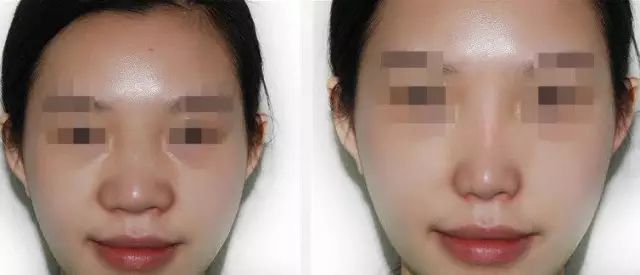 哈爾濱哪家醫(yī)院做隆鼻好？醫(yī)療技術(shù)排行幫你快速選擇