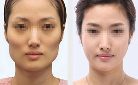 深圳隆胸醫(yī)院推薦：專業(yè)經(jīng)驗(yàn)豐富、口碑好的醫(yī)院