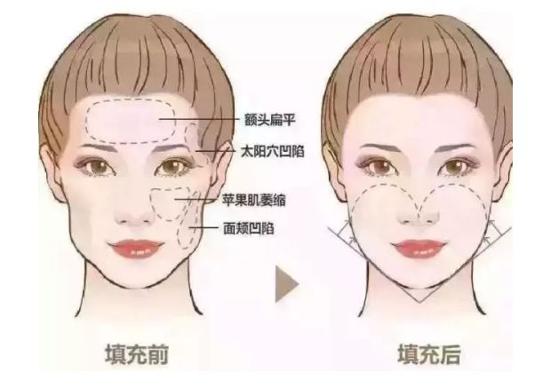 2024抗衰指南:權(quán)威機(jī)構(gòu)去皺項(xiàng)目效果測(cè)評(píng) 2024抗衰指南:權(quán)威機(jī)構(gòu)去皺項(xiàng)目效果測(cè)評(píng)