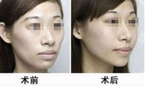 拉皮整形選擇趙絳波，打造無痕美顏，見證真實(shí)效果