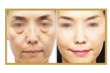 日照哪家醫(yī)院做雙眼皮手術(shù)技術(shù)高效？