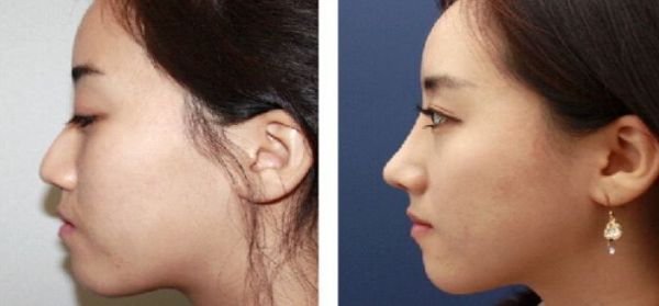 北京大腿抽脂專家推薦，哪個醫(yī)院技術好？