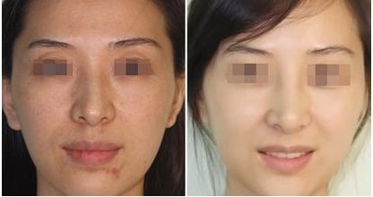 蘇州隆鼻醫(yī)院排名，專家推薦，有哪些？