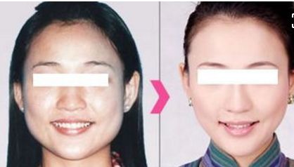 貴陽哪家醫(yī)院做自體脂肪豐蘋果肌比較好 貴陽哪家醫(yī)院做自體脂肪豐蘋果肌比較好