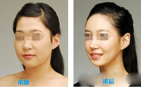 肌功能矯治，哪個階段適合兒童早期干預？哪些醫(yī)院堪稱專家？