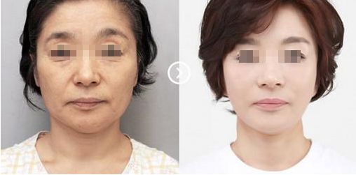 蘇州奧克拉醫(yī)院的整形效果及評價如何？