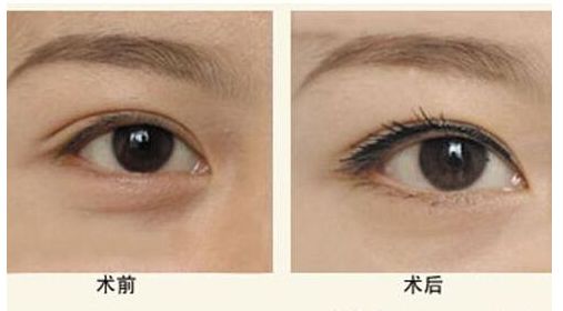 山東哪家醫(yī)院做膨體隆鼻效果好？