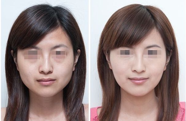 合肥哪家雙眼皮修復(fù)效果好？排名前十的整形醫(yī)院大揭秘