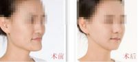 成都哪家醫(yī)院做自體豐胸效果更好？