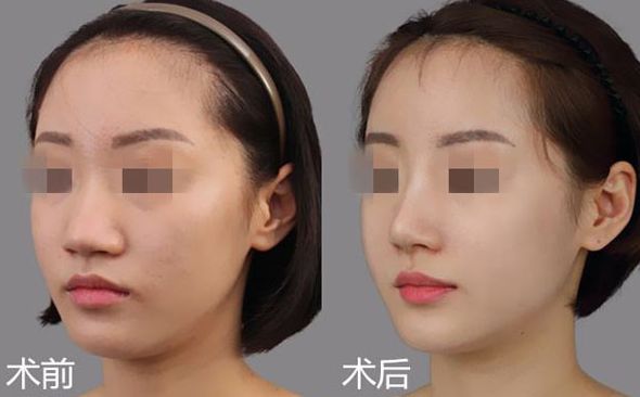 江門哪家醫(yī)院割雙眼皮效果好？