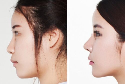 汕頭名流整形醫(yī)院：拉雙眼皮、吸脂價(jià)格一覽，專家解讀真實(shí)案例