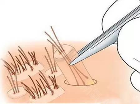 全國著名植發(fā)醫(yī)院排行榜！推薦您前往上海九院、新生等頂級機(jī)構(gòu)
