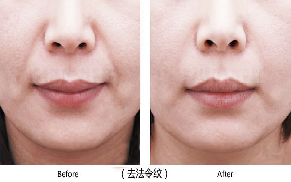 寶雞整容醫(yī)院大整頂級優(yōu)質(zhì)匯總！高一生對決愛容妍_絕對實力的對比震撼