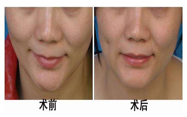 湖州雙眼皮手術(shù)機(jī)構(gòu)推薦：3家優(yōu)質(zhì)醫(yī)院完美整形，放心選擇