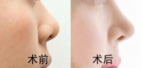 重慶現(xiàn)在有哪些當(dāng)代鼻子整形醫(yī)生值得關(guān)注？參考謝錦清和曾高醫(yī)生的口碑評價