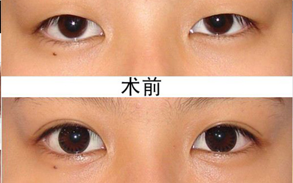 2023西安鼻基骨縮窄手術(shù)醫(yī)院排名前10強(qiáng)，值得信賴的口碑推薦！