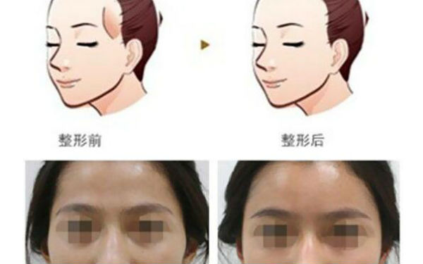 洛陽哪家醫(yī)院做木偶紋效果好？2023榜單出爐，洛陽物理去木偶紋top10佳選露面！