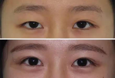 杭州駝峰鼻矯正哪家整形醫(yī)院技術(shù)獨(dú)特？2023杭州駝峰鼻矯正排名前10的醫(yī)院評(píng)測(cè)揭曉！