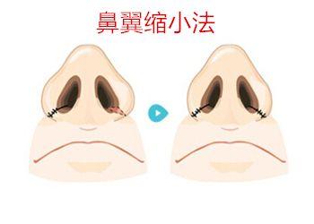 2023成都極具聲望的木偶紋填充玻尿酸醫(yī)療中心排行榜！驚喜揭曉