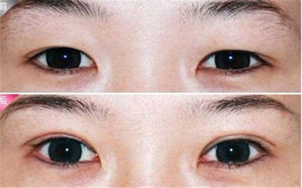 杭州哪家整形醫(yī)院效果好，專業(yè)解決祛痘坑痘印問題，2023很受歡迎的前十家！