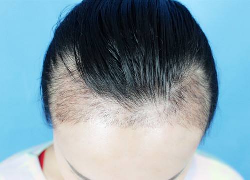 宜賓市哪家整形醫(yī)院專業(yè)豐額頭術(shù)效果好？探尋宜賓自體脂肪豐額頭術(shù)醫(yī)院口碑佳！2023宜賓豐額頭術(shù)推薦前十技