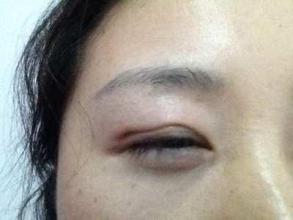 北京眼部熊貓針注射熱門醫(yī)院排名榜單揭秘，術(shù)前必看指南！