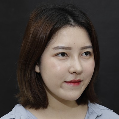 廣州美恩半肋鼻手術(shù)恢復(fù)效果反饋，主任親自操刀的效果就是贊！