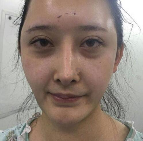 深圳陽光全臉填充術(shù)前術(shù)后對比，說年輕十歲不過分吧