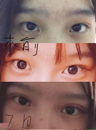 做雙眼皮案例，濟南坤如瑪麗崔金珍雙眼皮案例圖片