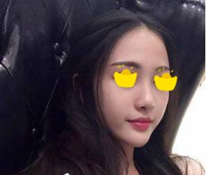 塌鼻子小妹在深圳鵬愛做隆鼻手術(shù)，三個(gè)月后竟然是這樣的