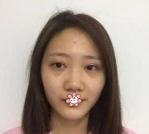 北京彤美耳軟骨隆鼻三個(gè)月效果分享，吐血推薦