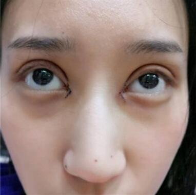 雙眼皮失敗丑的不敢見(jiàn)人，昆明麗都整形雙眼皮修復(fù)案例分享