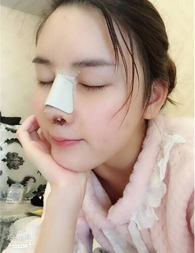 北京哪家隆鼻好？花一萬鼻子做成這樣值不值