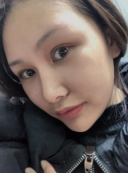 長春中研整形黃帝云鼻頭縮小案例術后一個月效果