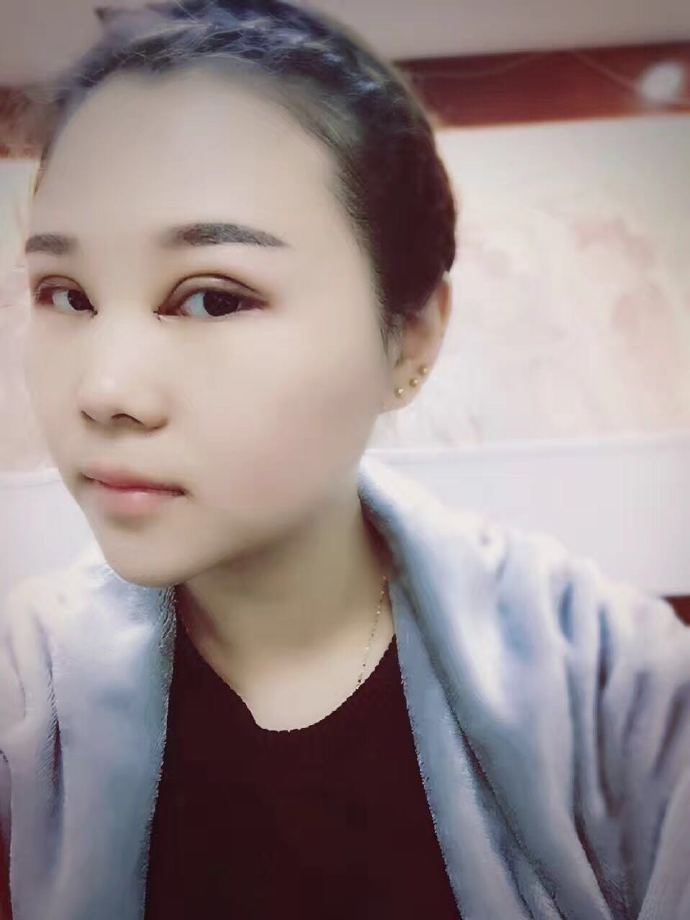 腫眼泡應(yīng)該做哪種雙眼皮？汕頭曙光雙眼皮三個(gè)月效果分享
