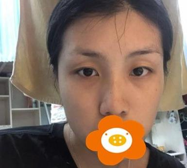 救命，周杰群做的耳軟骨隆鼻恢復(fù)后鼻背線條也太好看了吧