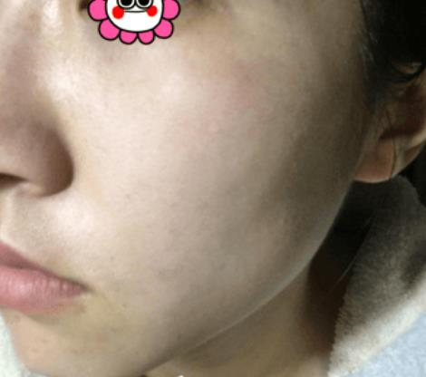 困惱我多年的斑，沒想到在溫州韓美三千塊錢就去掉了