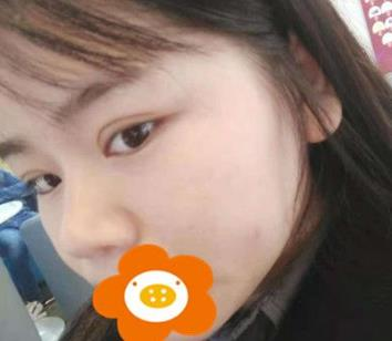 據說杭州薇琳隆鼻后效果很自然，有案例嗎