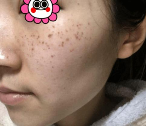 困惱我多年的斑，沒想到在溫州韓美三千塊錢就去掉了