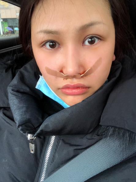 長春中研整形黃帝云鼻頭縮小案例術后第二天