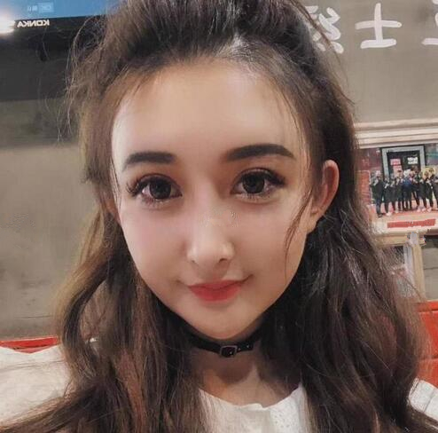 深圳陽光全臉填充術(shù)前術(shù)后對比，說年輕十歲不過分吧