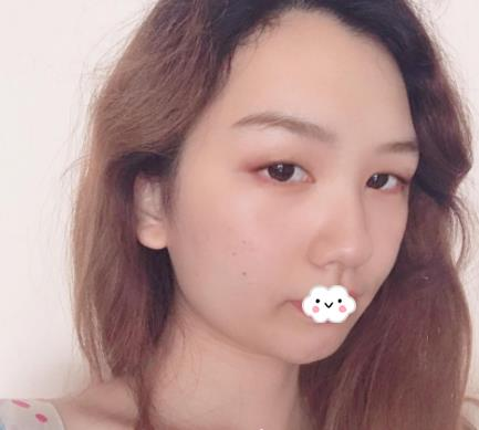 武漢伊萊美割雙眼皮怎么樣？切開雙眼皮恢復(fù)過程圖