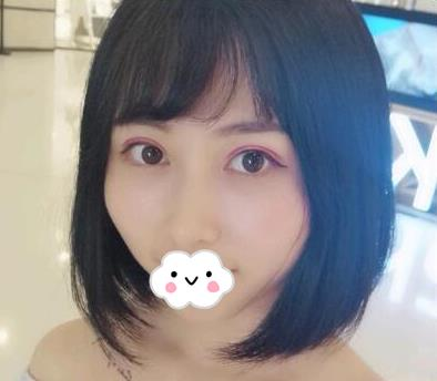 武漢亞太整形雙眼皮術后一個月效果分享
