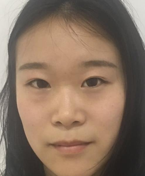 石家莊諾萬整形肋軟骨隆鼻案例分享，恢復(fù)過程圖