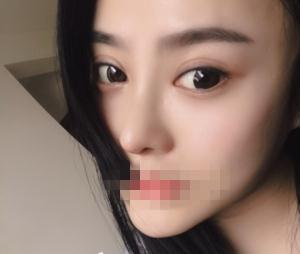 親身經(jīng)驗(yàn)，重慶星范整形的超體隆鼻真的很自然