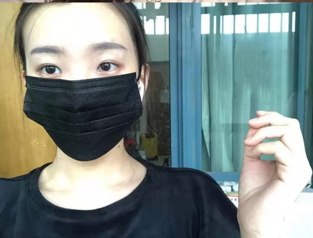 做雙眼皮案例，北京藝星張順慶雙眼皮案例圖片