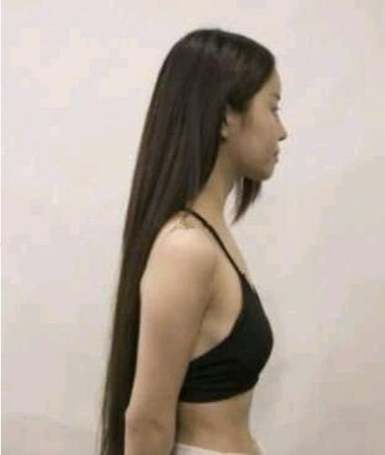 青島集美蜜桃假體隆胸案例術前效果