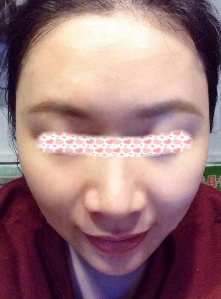 像我一樣寬鼻翼的小姐姐們可以放心找李旭平做隆鼻了，親測好評
