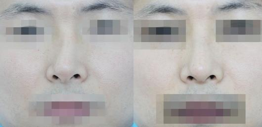 不要被營銷號帶偏了，鼻骨矯正其實很簡單