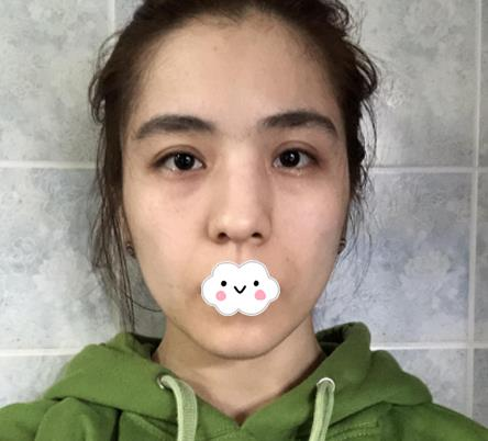 大連沙醫(yī)生整形付德林做的自體軟骨隆鼻效果，給大家做個參考
